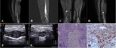 Sciatic nerve schwannoma complicated by nerve bundle membrane effusion: Two case reports and a literature review